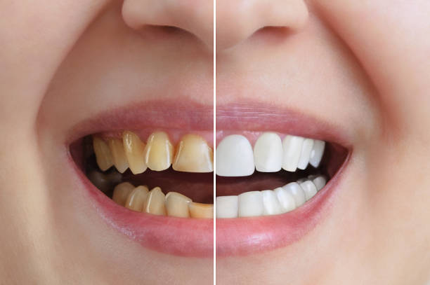 Treatment and whitening of teeth, Before and after.