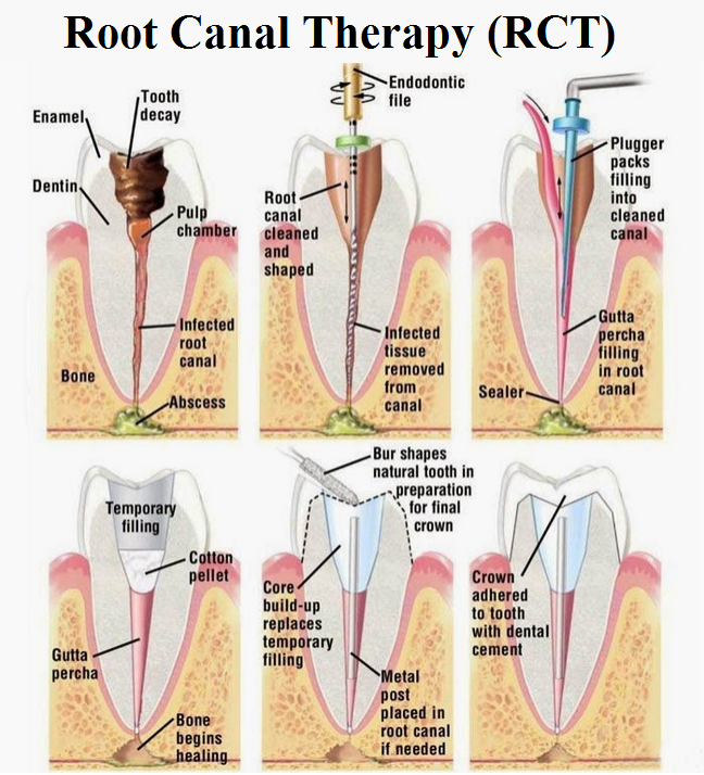 Root Canal Therapy