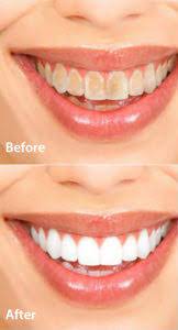 Cosmetic Dentistry - Before and after