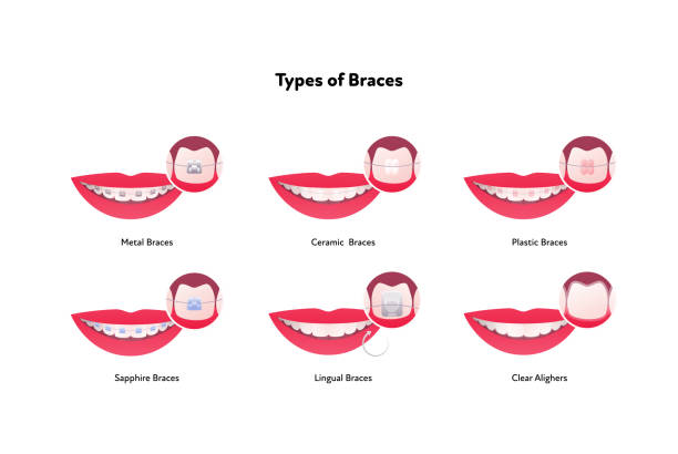 Dental teeth braces