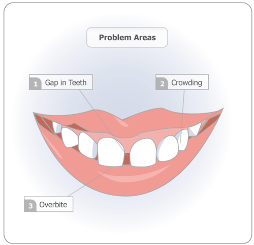 Dental teeth braces