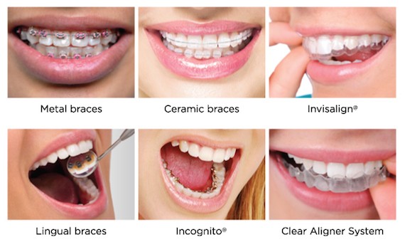 Dental teeth braces