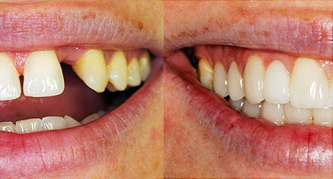 Cosmetic Dentistry - Before and after