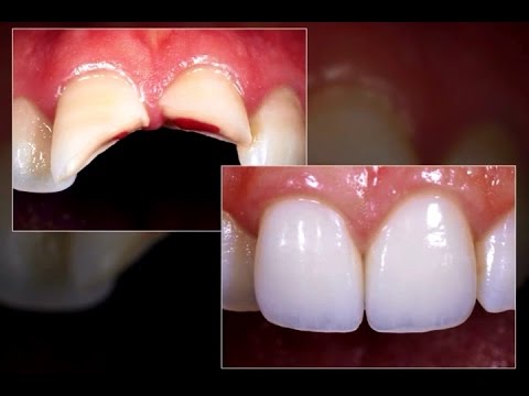 Dental Crown Procedure