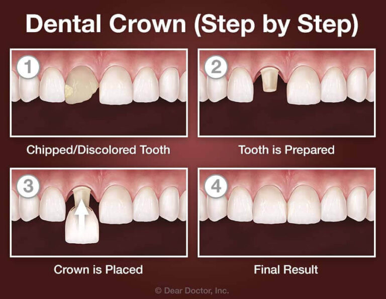 Dental Crown Procedure