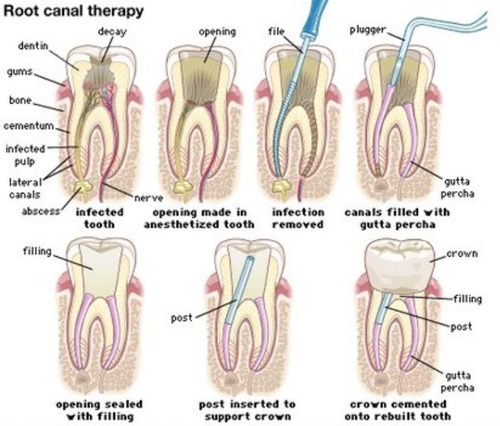 Root Canal Therapy