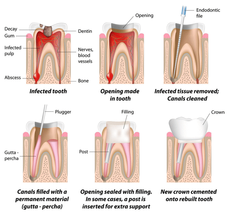 Root Canal Therapy