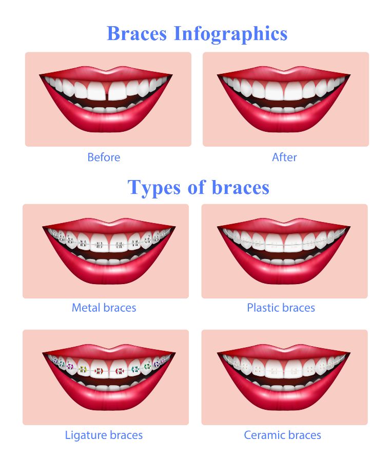 Dental teeth braces