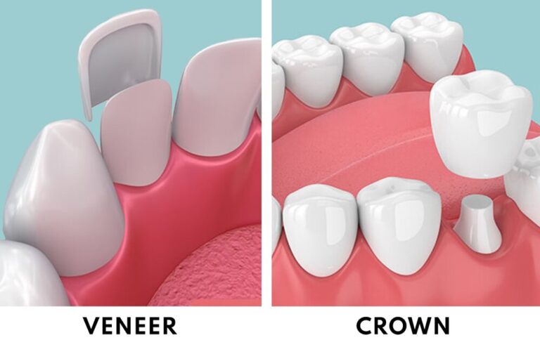 Dental Crown