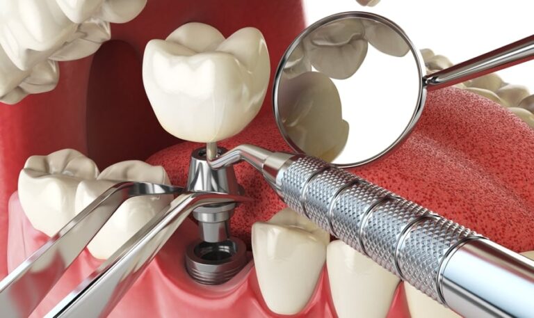 Dental Implant