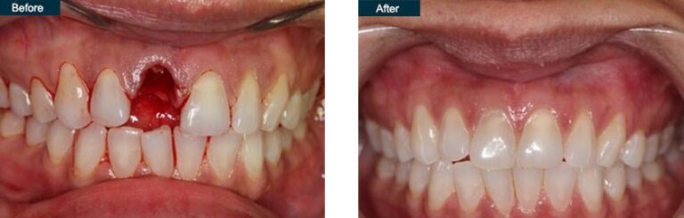 Dental Implant