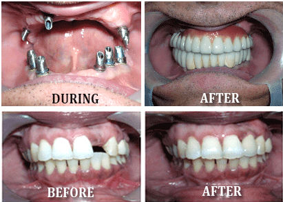 Dental Implant