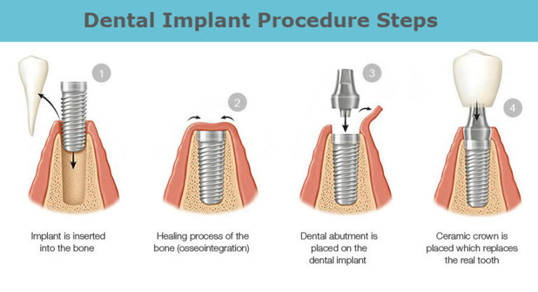 Dental Implant